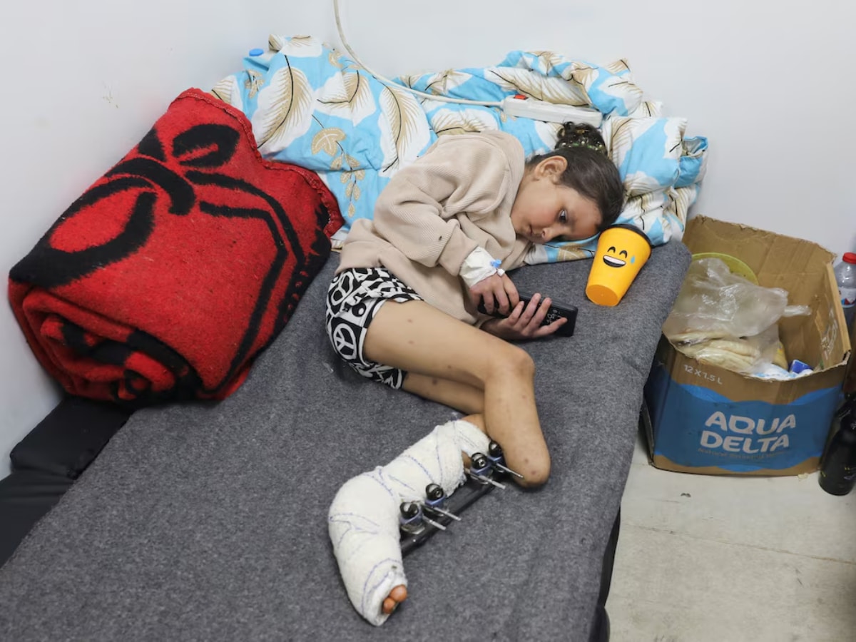 Gaza, where amputation has become the only option to save lives