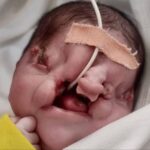 Gaza congenital disability surges amid fallout of Israel's genocide