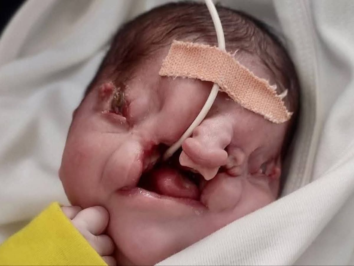 Gaza congenital disability surges amid fallout of Israel's genocide